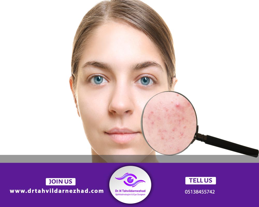 علت جوش های صورت و بدن چیست؟