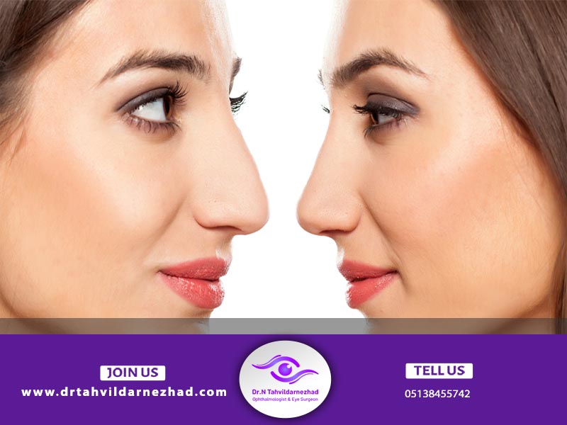 آیا پس از عمل بینی، نیاز به عمل زیبایی چشم است؟