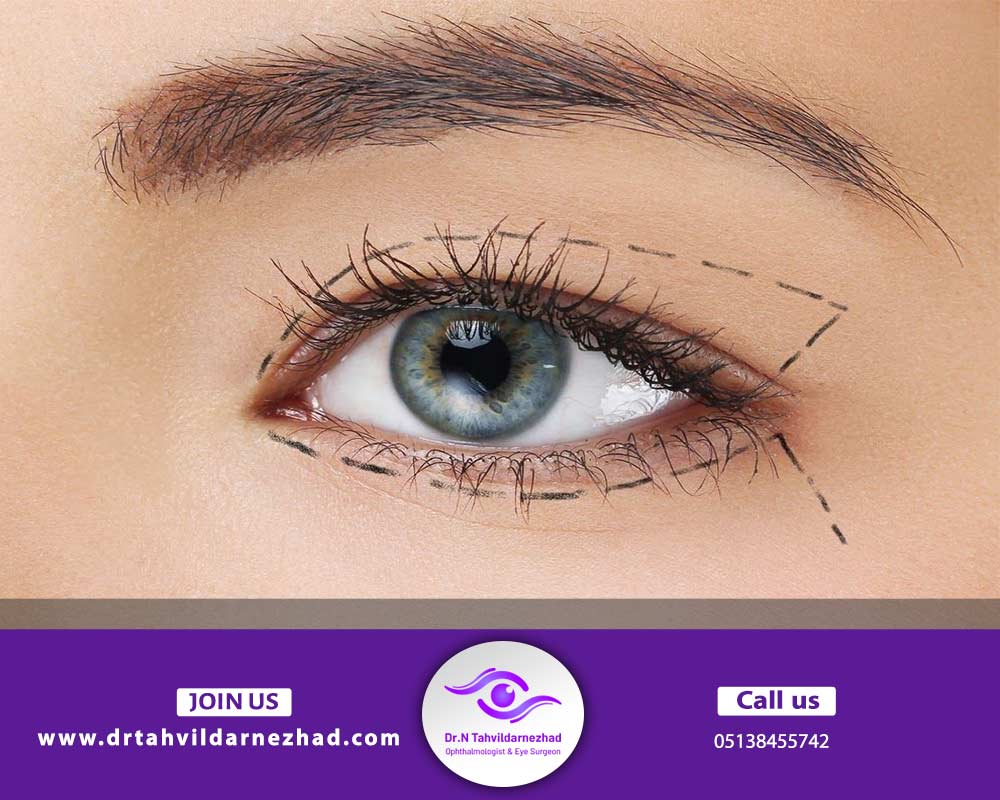 چگونه جراحی چشم گربه ای انجام می شود
