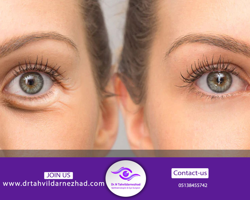 تاثیرات لیزر در ازبین بردن چروک دور چشم