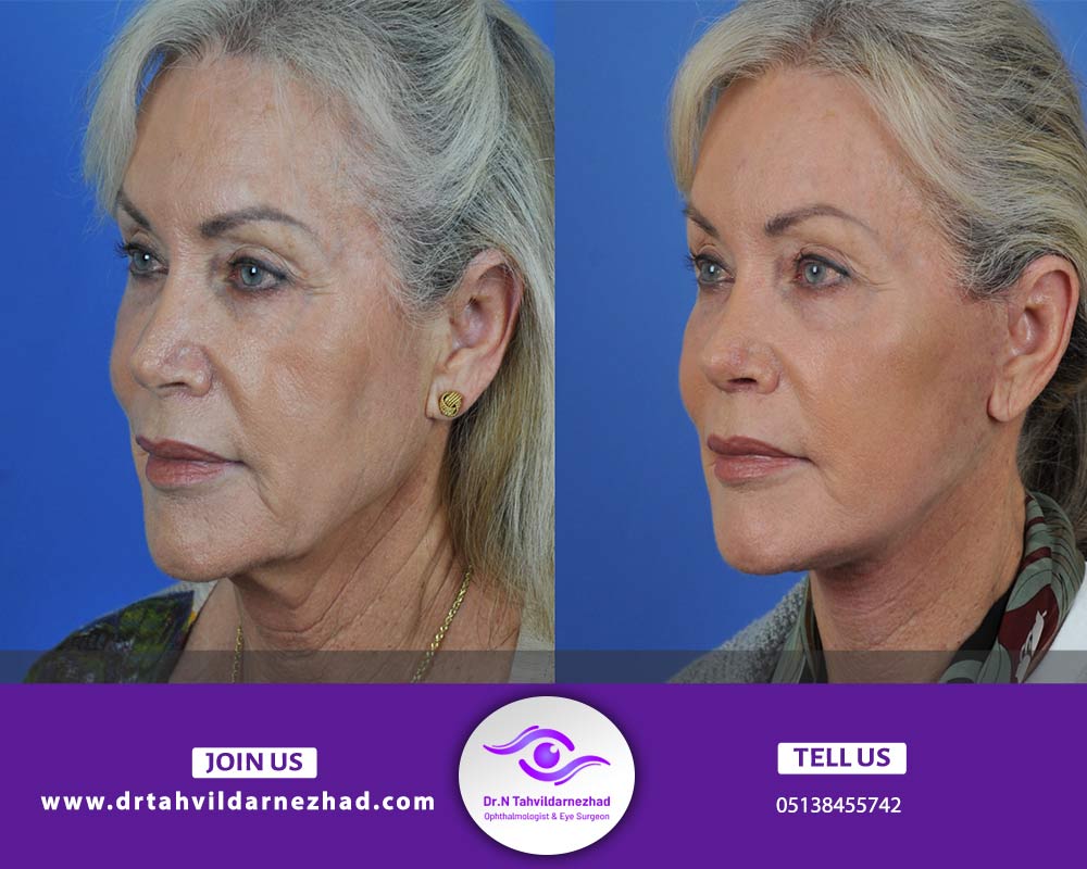 مزایای لیفت کامل آندوسکوپی پیشانی، ابرو، شقیقه