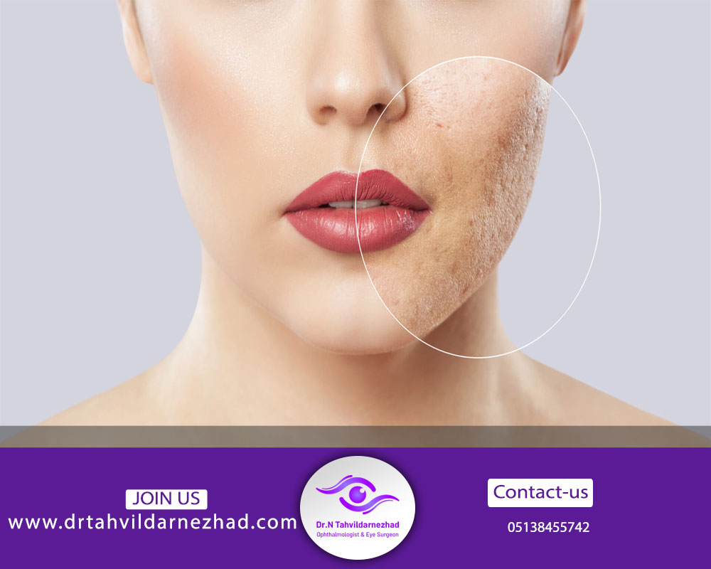 تفاوت عمده بین روش آر اف فرکشنال با co2 فرکشنال چیست؟