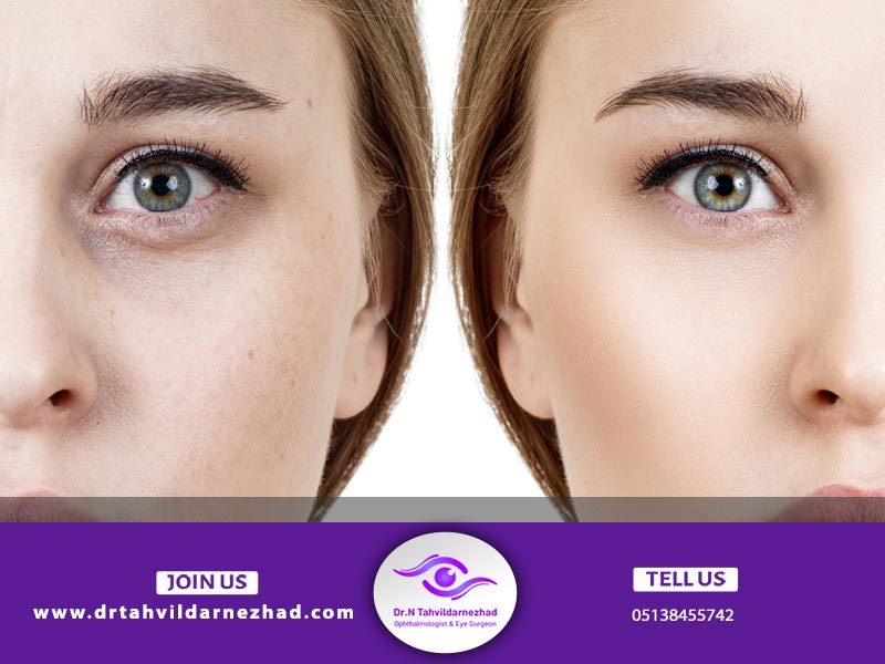 بررسی علل فرورفتگی دور چشم + نحوه درمان آن