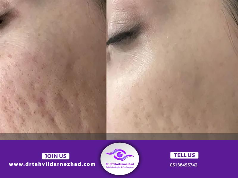 پلاسماتراپی چه کاربردی دارد؟