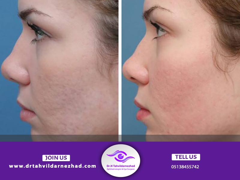 سابسیژن چیست و چه کاربردی دارد؟