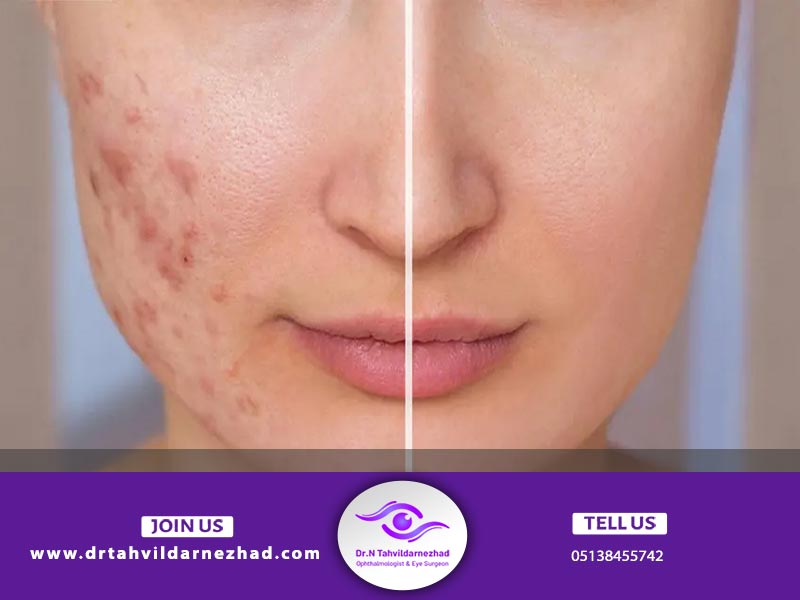 کاربردهای سابسیژن پوست