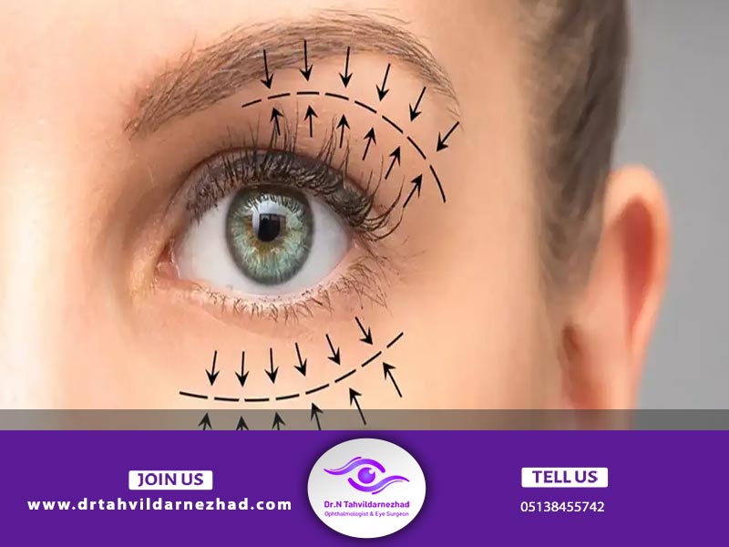ماندگاری Transconjugate blepharoplasty