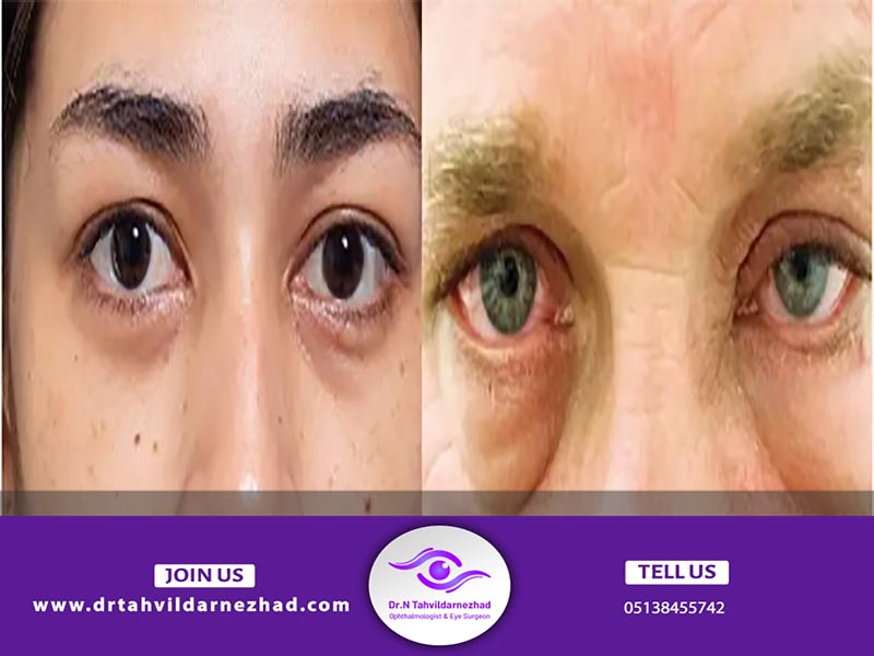 علائم میوپاتی چشمی چیست؟