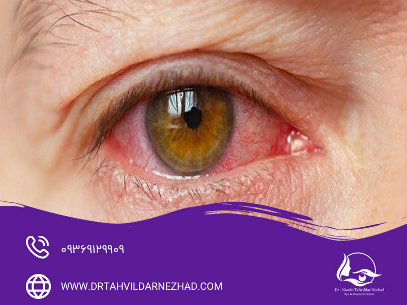چالش‌های بیماران مبتلا به فشار چشم در جراحی زیبایی پلک