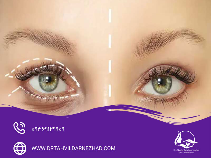 آیا بیماران مبتلا به فشار چشم می‌توانند جراحی زیبایی پلک انجام دهند؟
