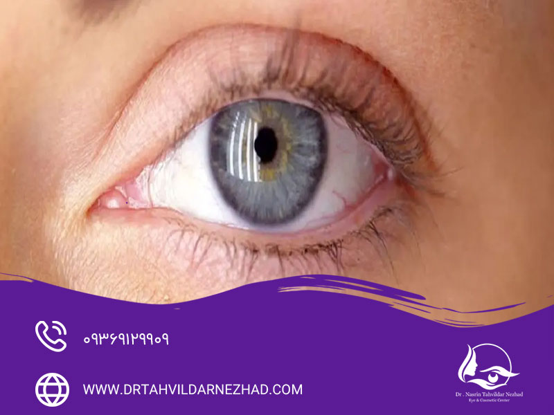 تاثیر فشار چشم بر سلامت عمومی چشم