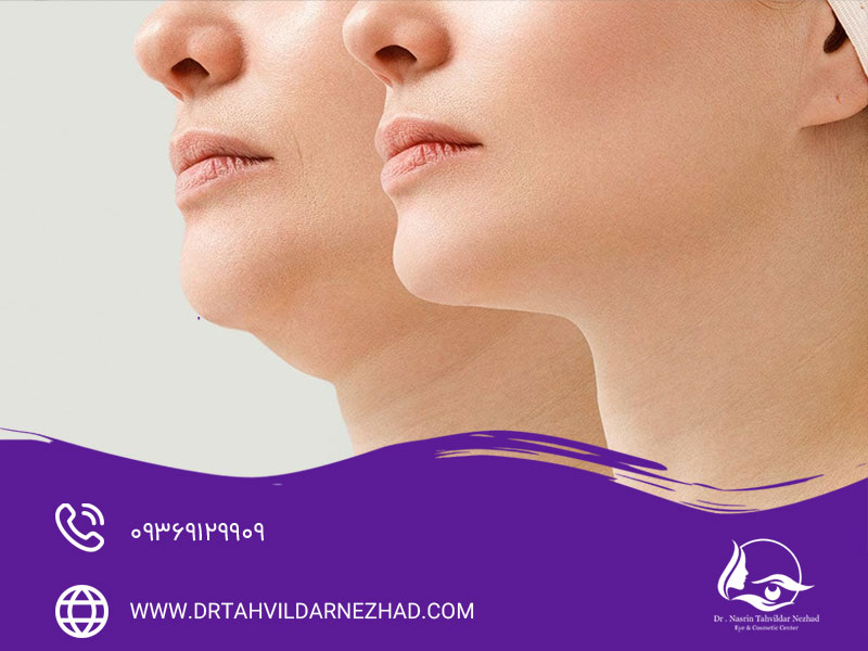 همه چیز درباره ساکشن غبغب