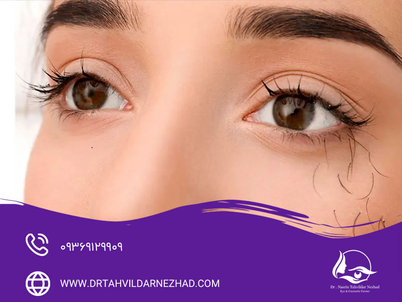 دلایل اصلی ریزش مژه