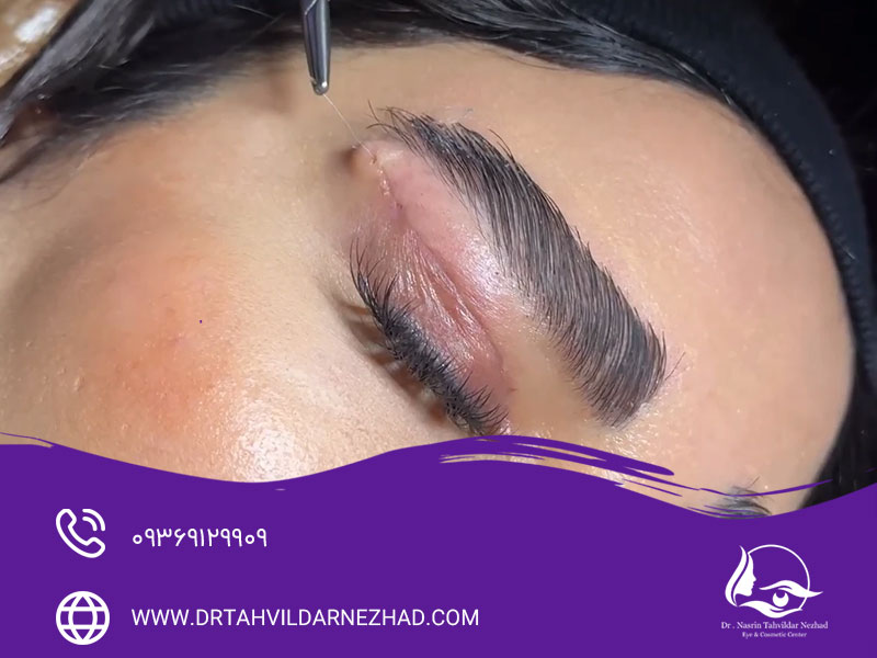 روش های رفع جای بخیه ناشی از بلفاروپلاستی