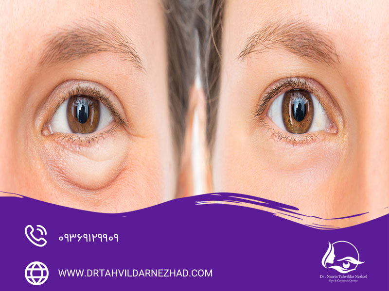 ماندگاری تزریق چربی زیر چشم