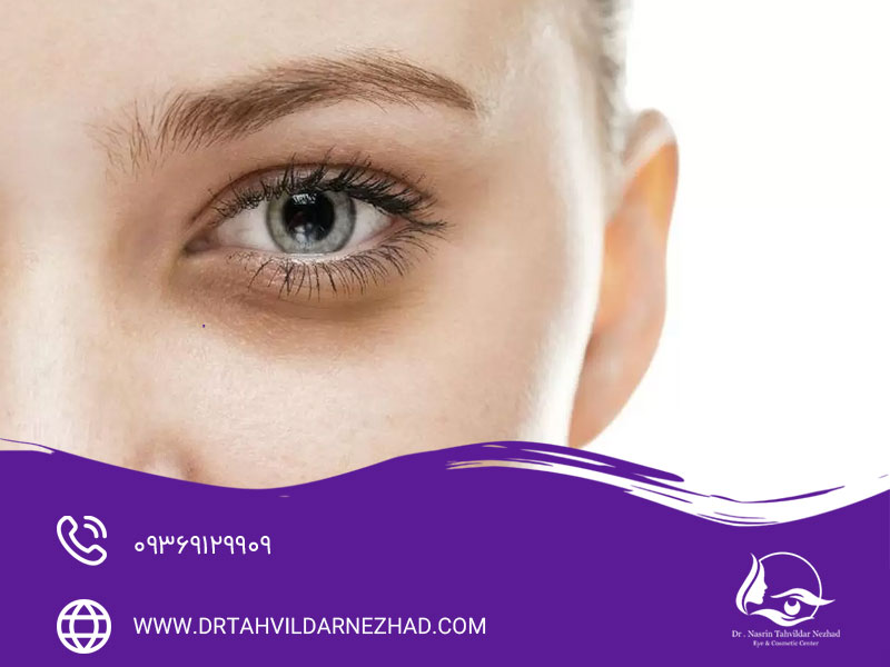 چه افرادی بهترین گزینه برای PRP زیر چشم هستند؟