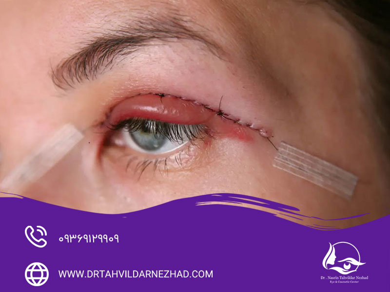 بیماری‌ها و شرایط پزشکی موثر بر ترمیم زخم