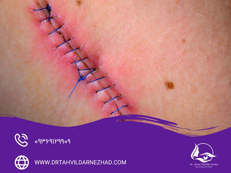 مهم‌ترین علائم عفونت بخیه کدامند؟