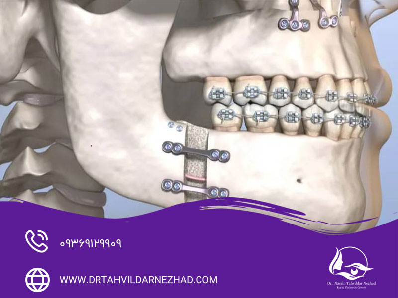 پروتز چانه بهتر است یا جنیوپلاستی؟ بررسی جامع روش‌های فرم‌دهی چ