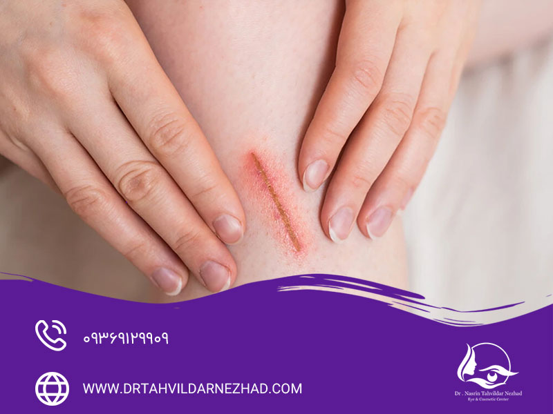 استفاده از آب استریل برای زخم