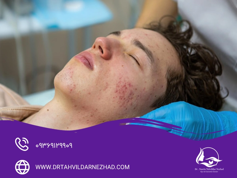 نکات تخصصی برای مدیریت آکنه شدید