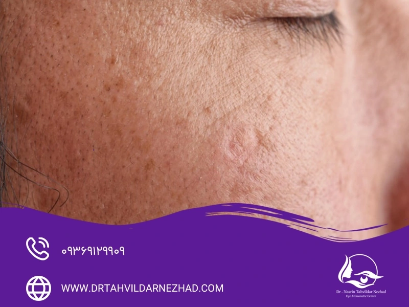 روش‌های تخصصی درمان پیگمنتیشن