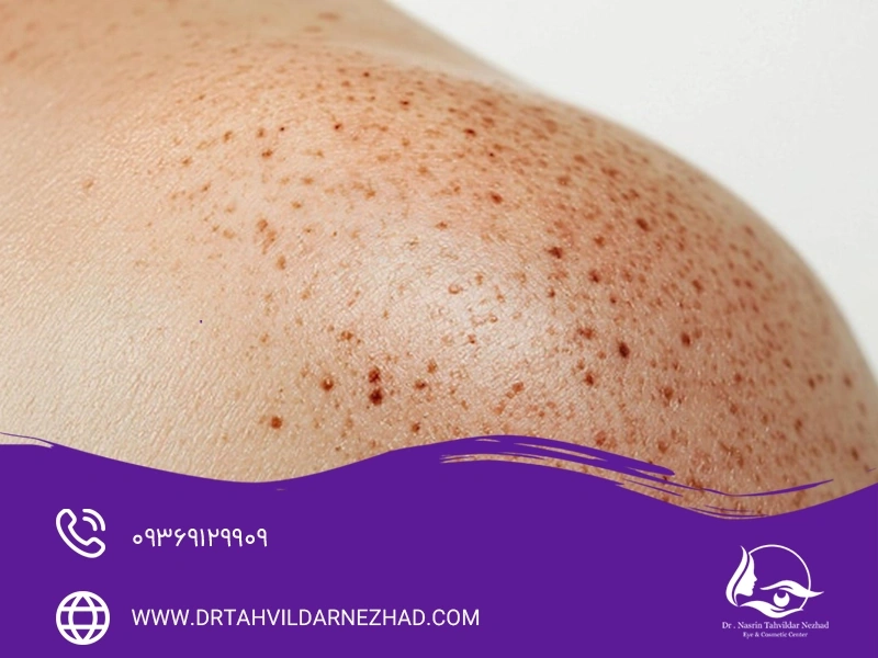 شناخت علل اصلی ایجاد لک‌های پوستی