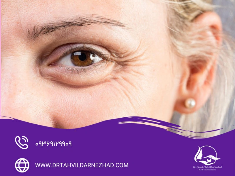 نقش عینک آفتابی در پیشگیری از چین و چروک اطراف چشم