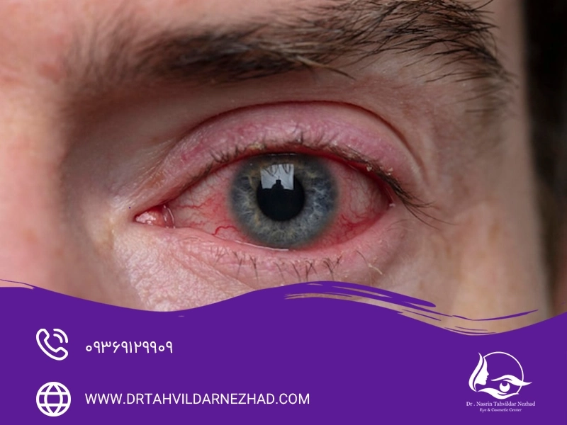 علائم عفونت چشم بعد عمل لیزیک