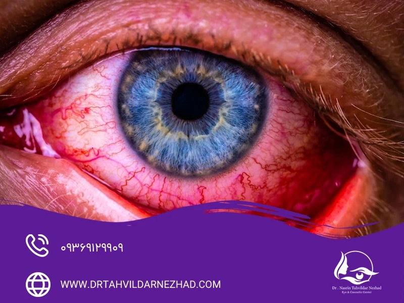 قرمزی غیرعادی چشم