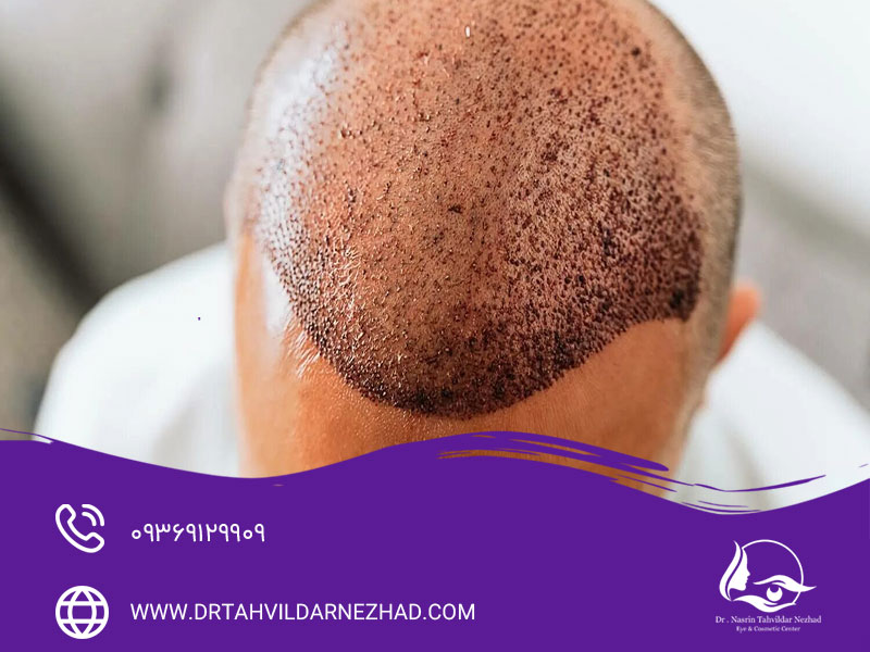 پماد موپیروسین برای بعد از کاشت مو