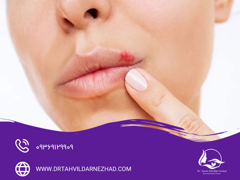 پماد موپیروسین برای تبخال
