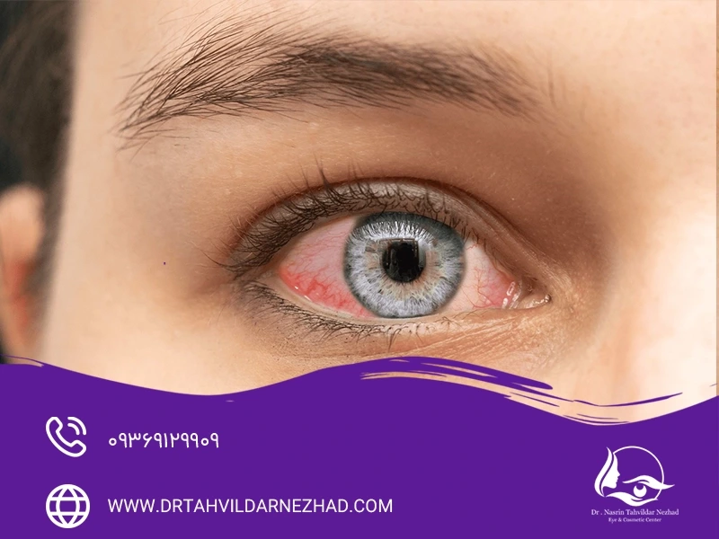 علت قرمزی چشم