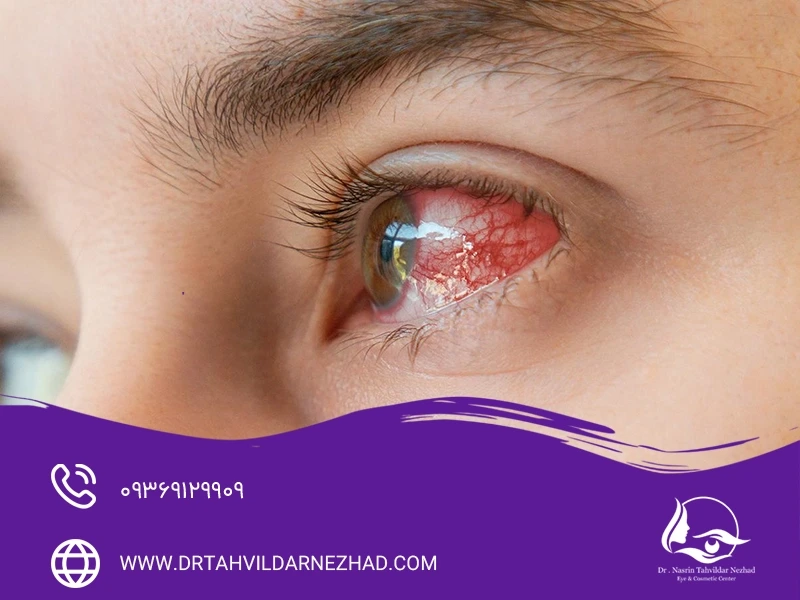 قطره برای رفع قرمزی چشم