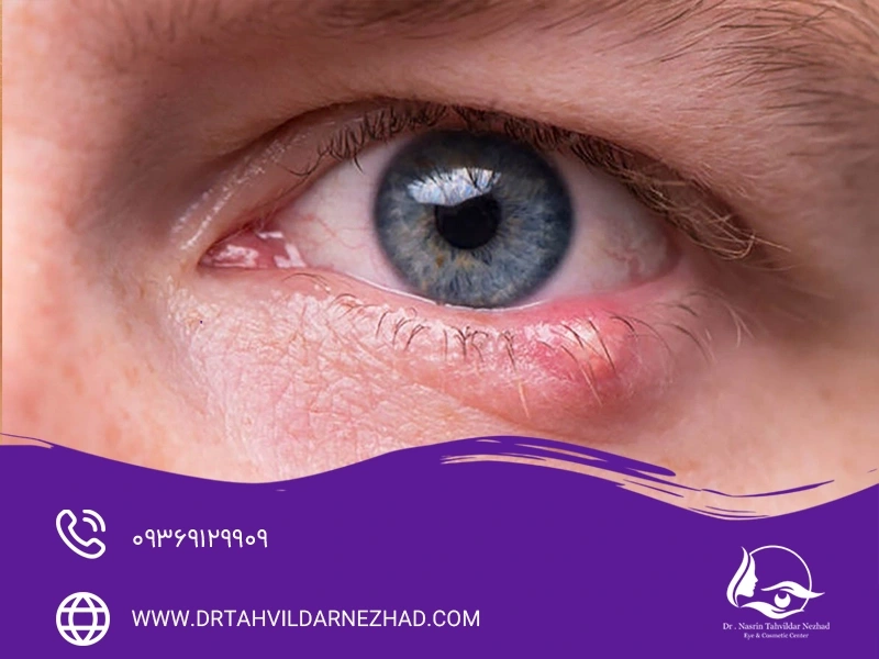 بررسی کامل گل مژه و شالازیون