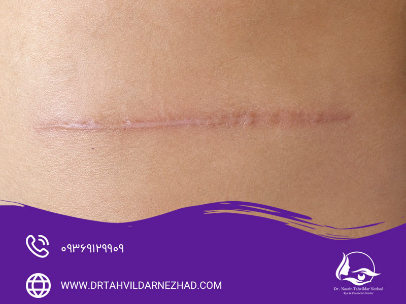 نحوه استفاده صحیح از کرم اسکار رژودرم برای جای بخیه