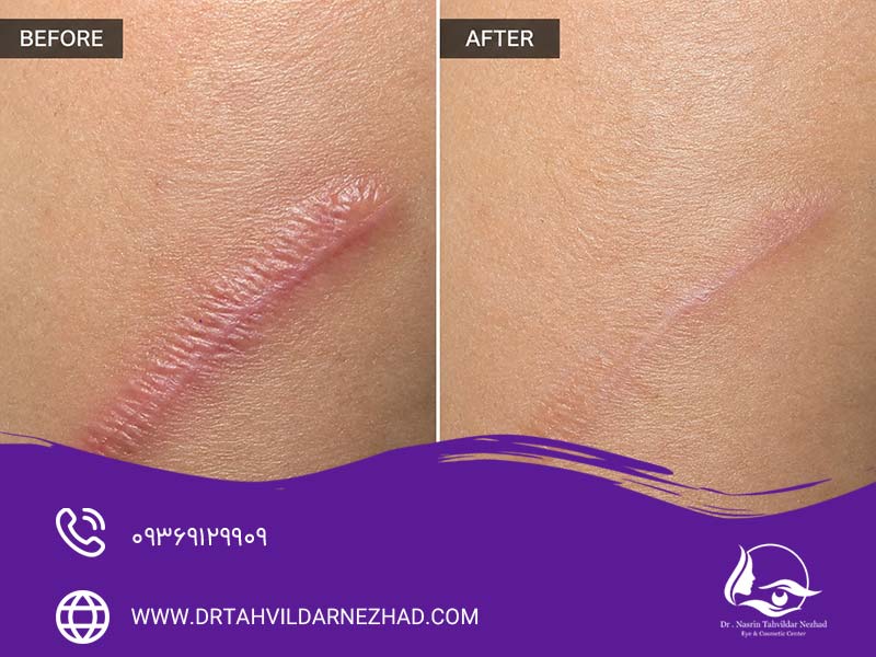 کرم اسکار رژودرم چیست و چگونه عمل می‌کند