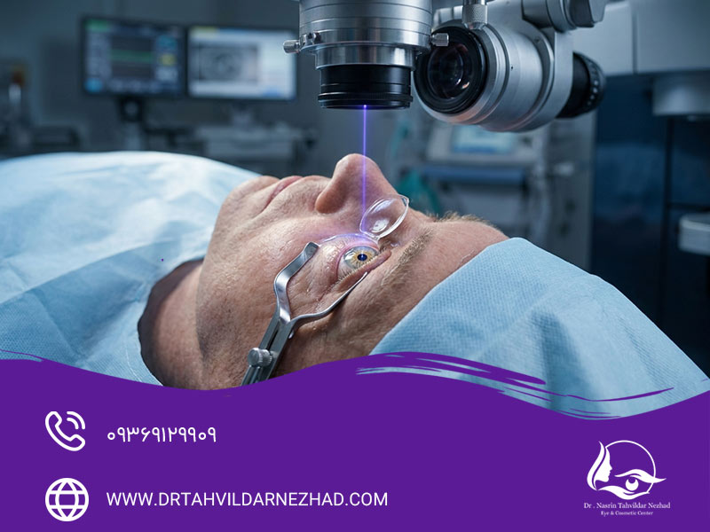 جراحی لیزیک برای درمان آستیگماتیسم