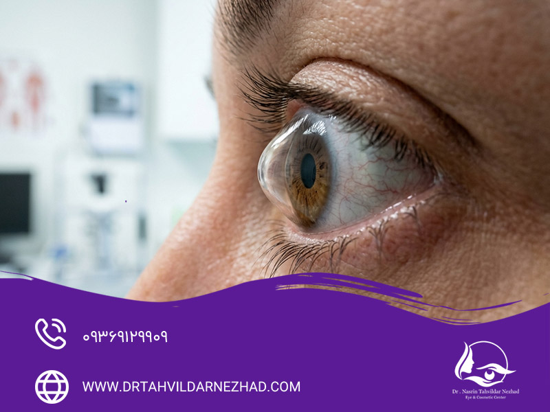 علت ابتلا به قوز قرنیه چشم