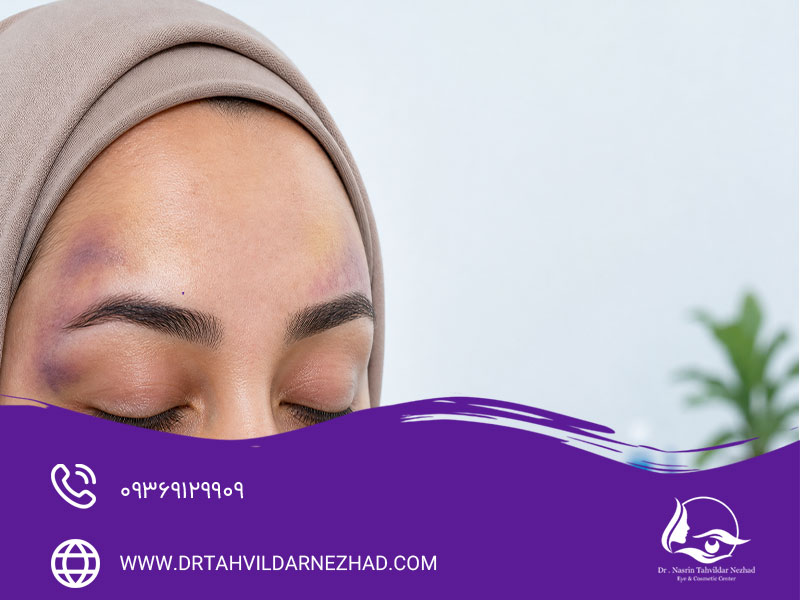 التهاب و کبودی بعد از لیفت ابرو با نخ
