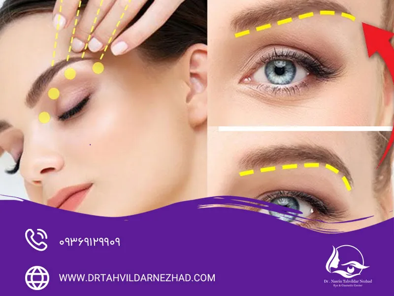 مهم ترین عوارض لیفت ابرو با نخ
