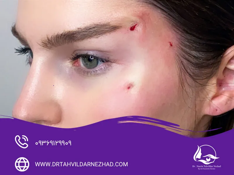 عوارض لیفت ابرو با نخ