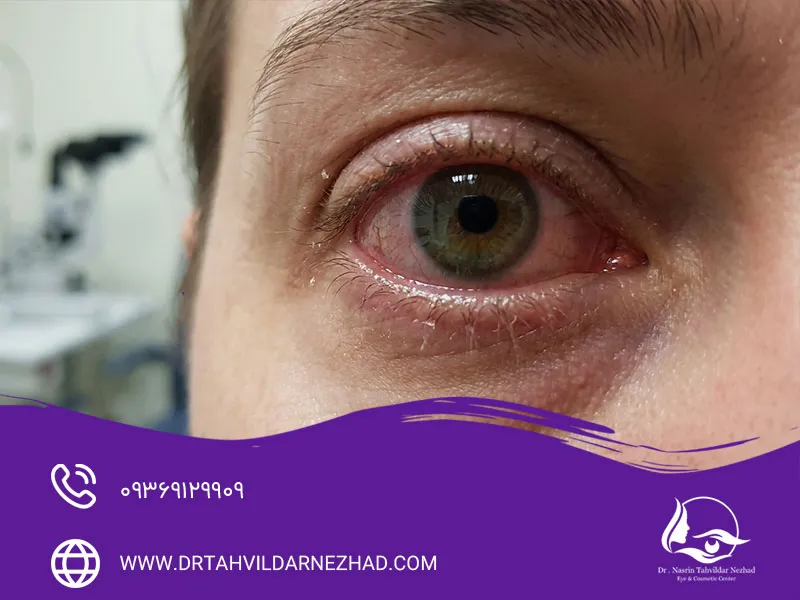 مهم‌ترین علائم خشکی چشم